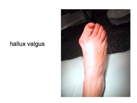 Hallux valgus img Hallux valgus