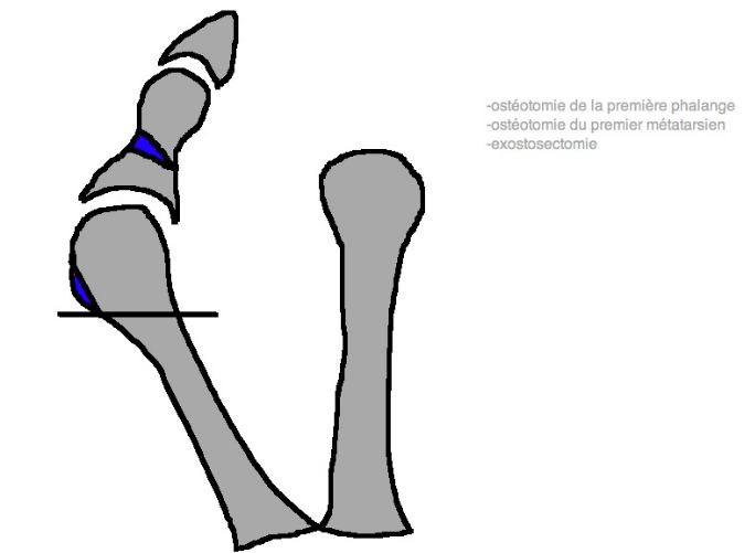 Hallux valgus img Hallux valgus