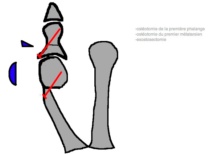 Hallux valgus img Hallux valgus