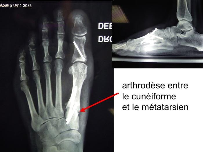 Hallux valgus img Hallux valgus