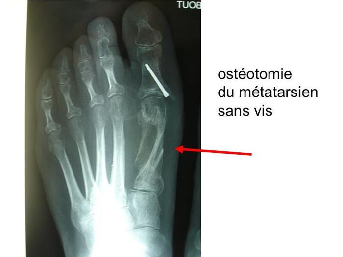 Hallux valgus img Hallux valgus