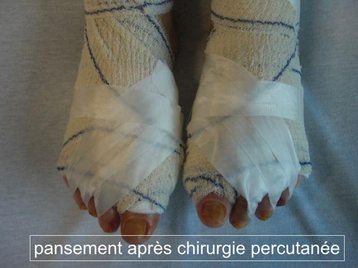 Hallux valgus img Hallux valgus