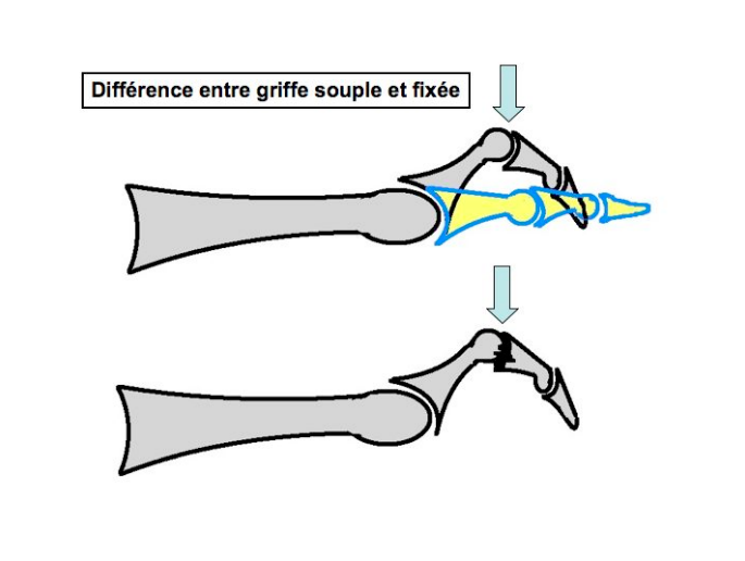 Griffes d'orteils img Griffes d