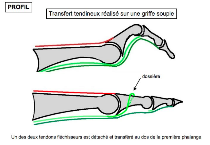 Griffes d'orteils img Griffes d