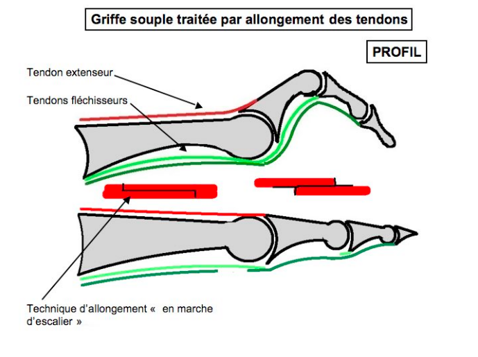 Griffes d'orteils img Griffes d