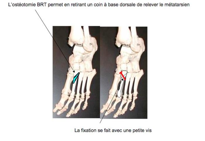 Les métatarsagies img Les métatarsagies