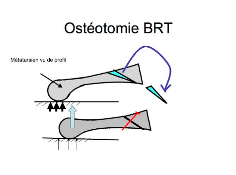 Les métatarsagies img Les métatarsagies