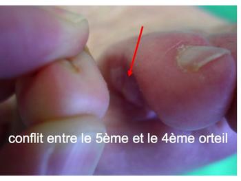 Griffe du 5ème orteil img Griffe du 5ème orteil