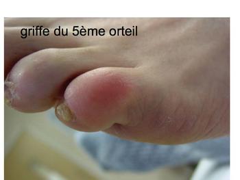 Griffe du 5ème orteil img Griffe du 5ème orteil