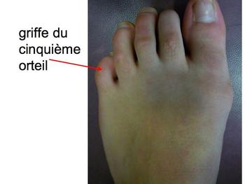 Griffe du 5ème orteil img Griffe du 5ème orteil