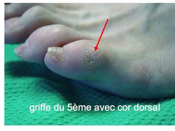 Griffe du 5ème orteil img Griffe du 5ème orteil