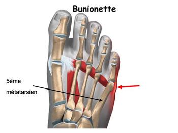 Bunionette img Bunionette
