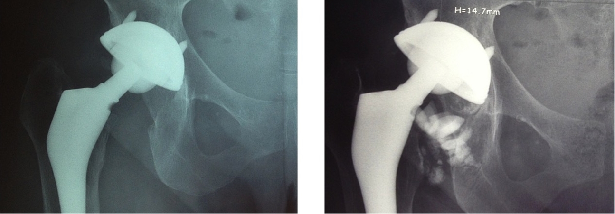 Fracture prothèse de hanche img Fracture prothèse de hanche