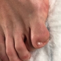 Exemple de polydactylie img Exemple de polydactylie