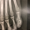 Exemple de polydactylie img Exemple de polydactylie