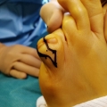Exemple de polydactylie img Exemple de polydactylie