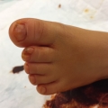 Exemple de polydactylie img Exemple de polydactylie