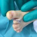 Exemple de polydactylie img Exemple de polydactylie