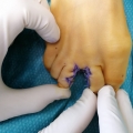 Syndactylie img Syndactylie