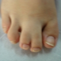 Syndactylie img Syndactylie