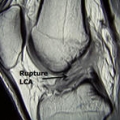Ligaments du genou img Ligaments du genou