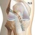 Ligaments du genou img Ligaments du genou