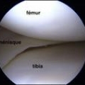 Ménisques du genou img Ménisques du genou