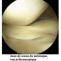 Ménisques du genou img Ménisques du genou