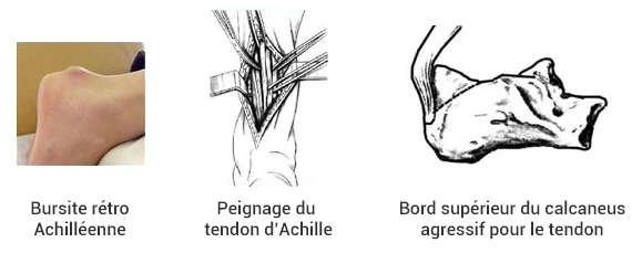 Tendinite d'Achille