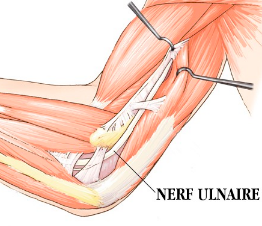 Le nerf ulnaire (anciennement nerf cubital) est un des nerfs du membre suprieur ayant un rle  la fois moteur et sensitif. Il est responsable de la sensibilit de la face palmaire de l'annulaire et de l'auriculaire et innerve de nombreux muscles de