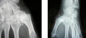 Rhizarthrose