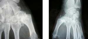 Rhizarthrose